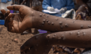 GHS Confirms 22 New Mpox Infections, Urges Public Caution